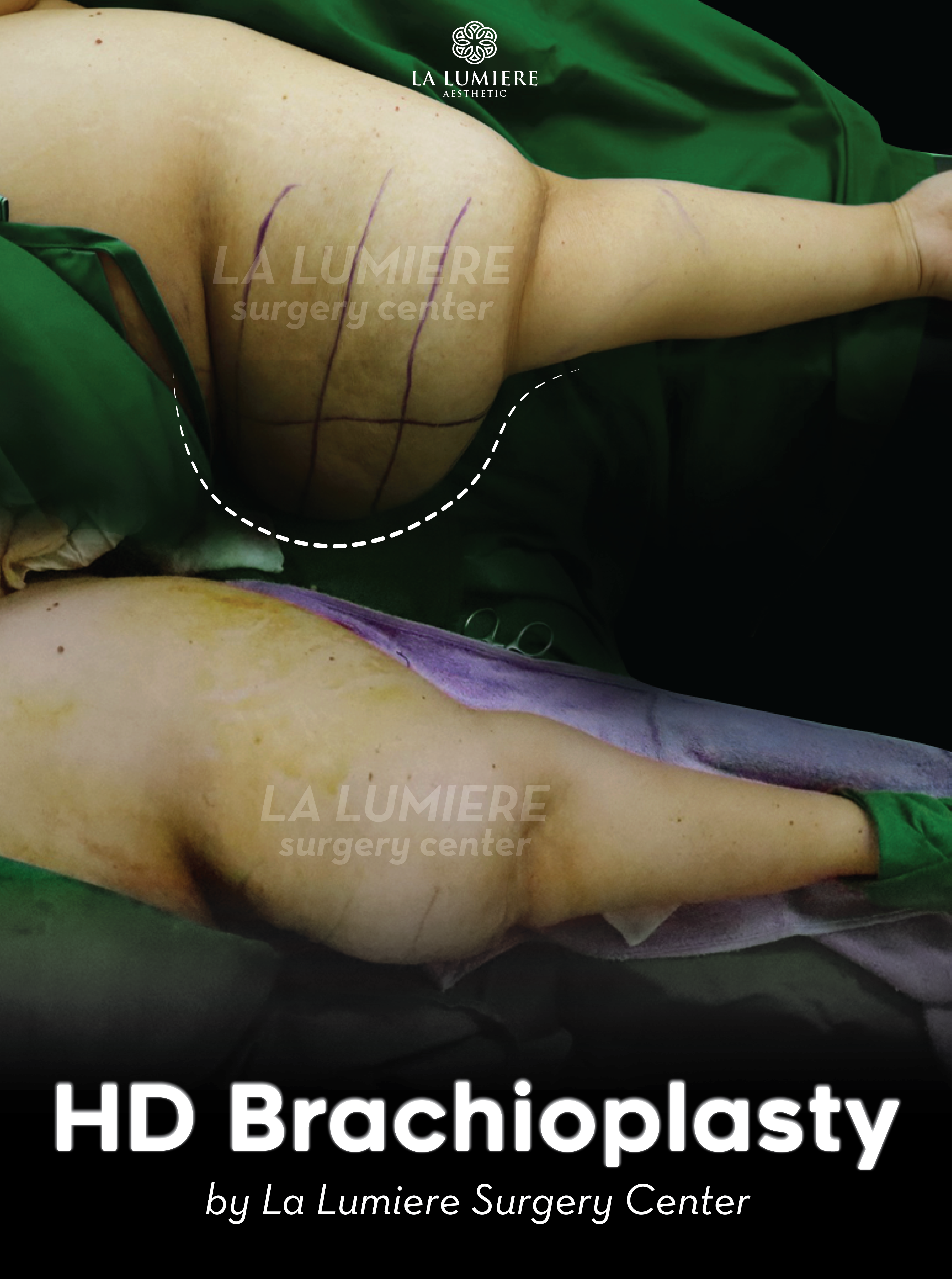 before-after-gynecomastia-la-lumiere-aesthetics-jakarta-01