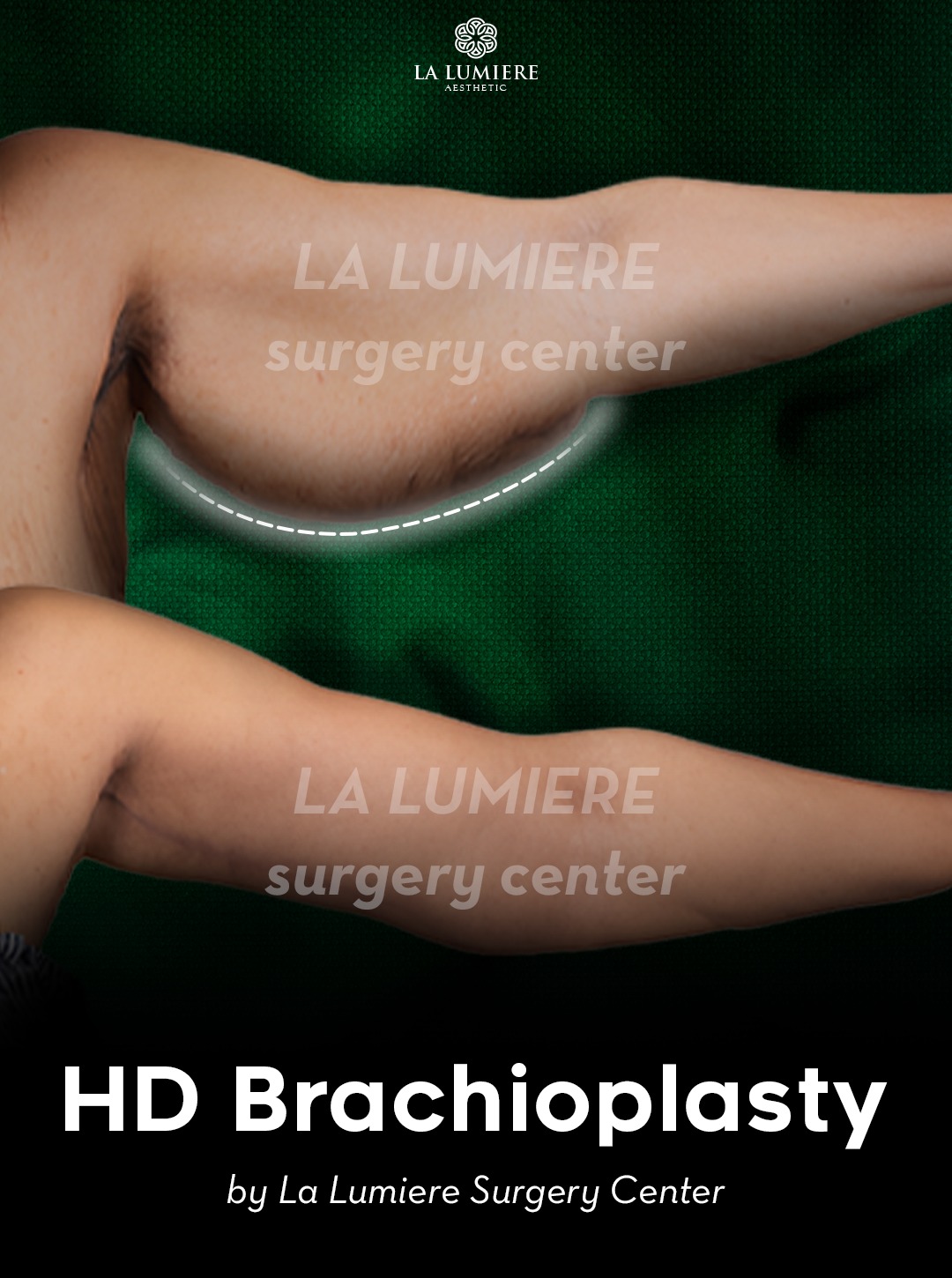 before-after-brachioplasty-la-lumiere-aesthetics-jakarta-01