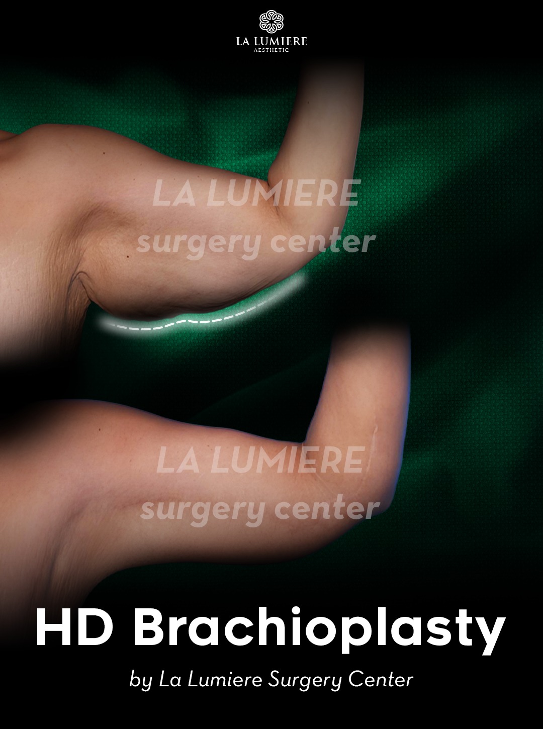 before-after-brachioplasty-la-lumiere-aesthetics-jakarta-01