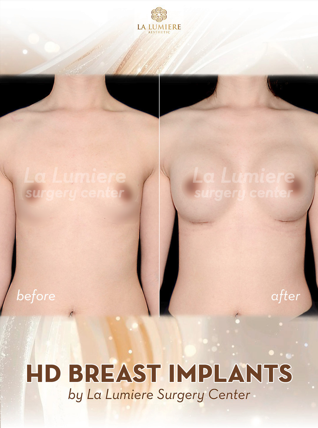 breast-implant-lla-1