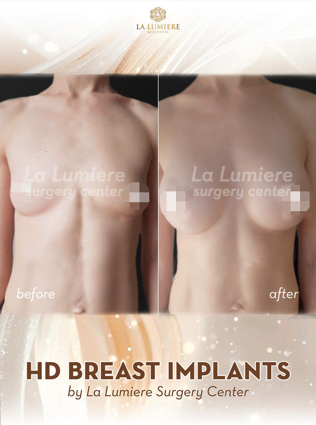 breast-implant-lla-1