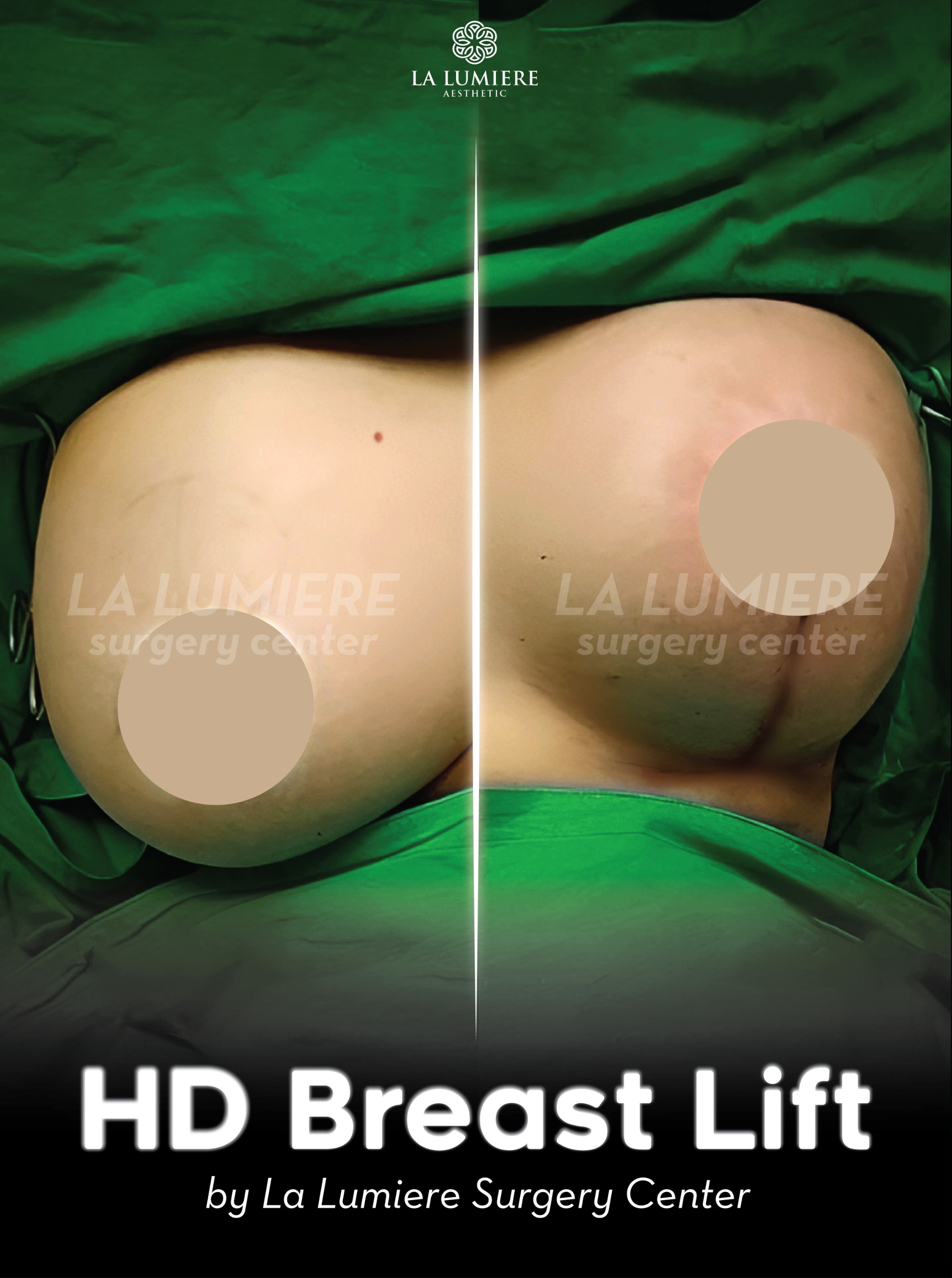 before-after-breast-lift-la-lumiere-aesthetics-jakarta-03