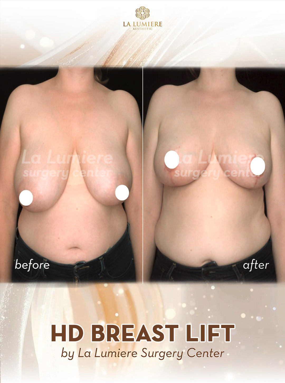 before-after-breast-lift-la-lumiere-aesthetics-jakarta-02