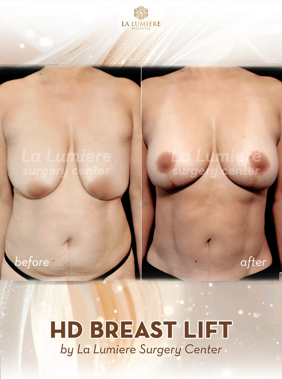 before-after-breast-lift-la-lumiere-aesthetics-jakarta-03