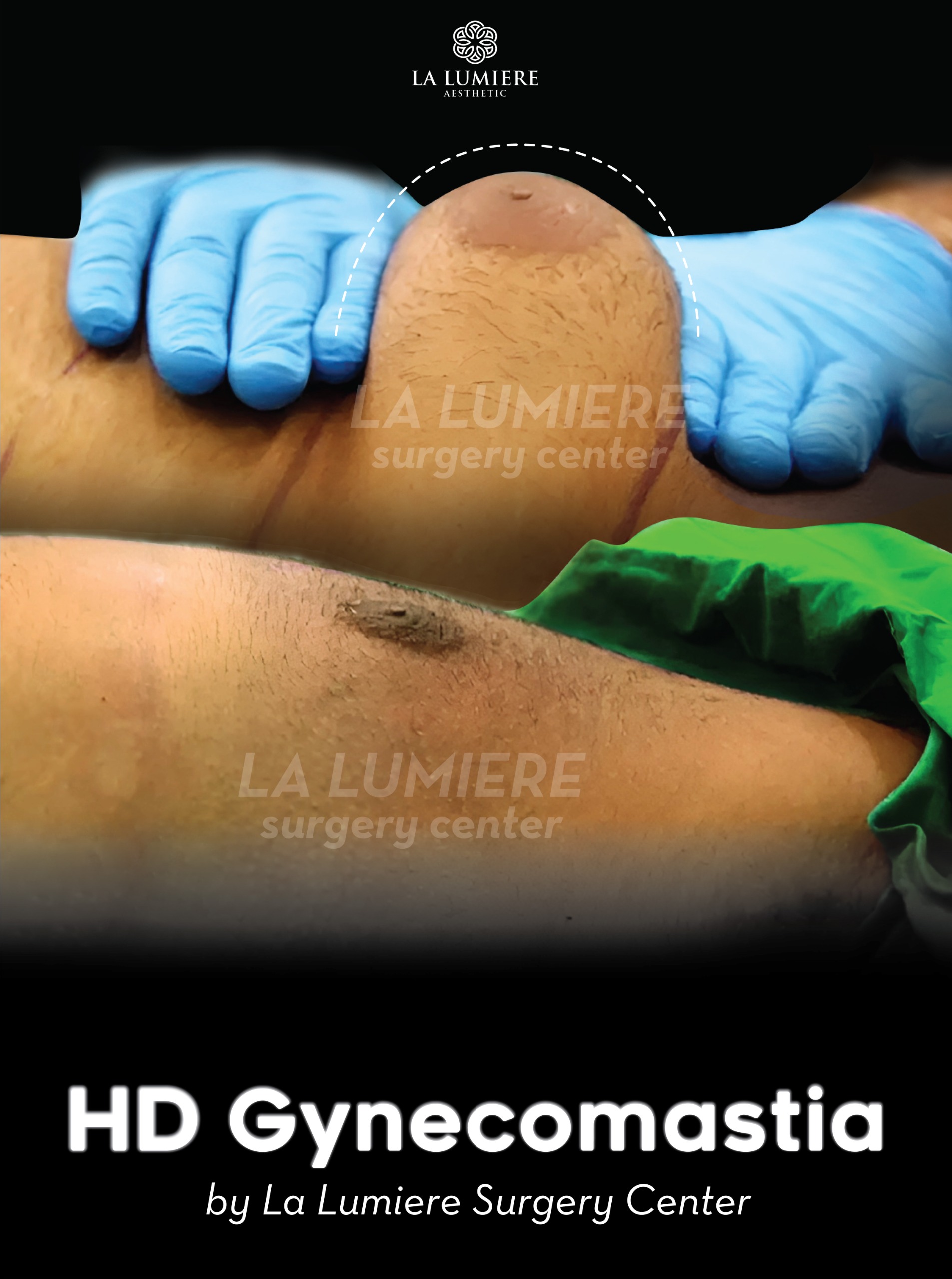 before-after-gynecomastia-la-lumiere-aesthetics-jakarta-02