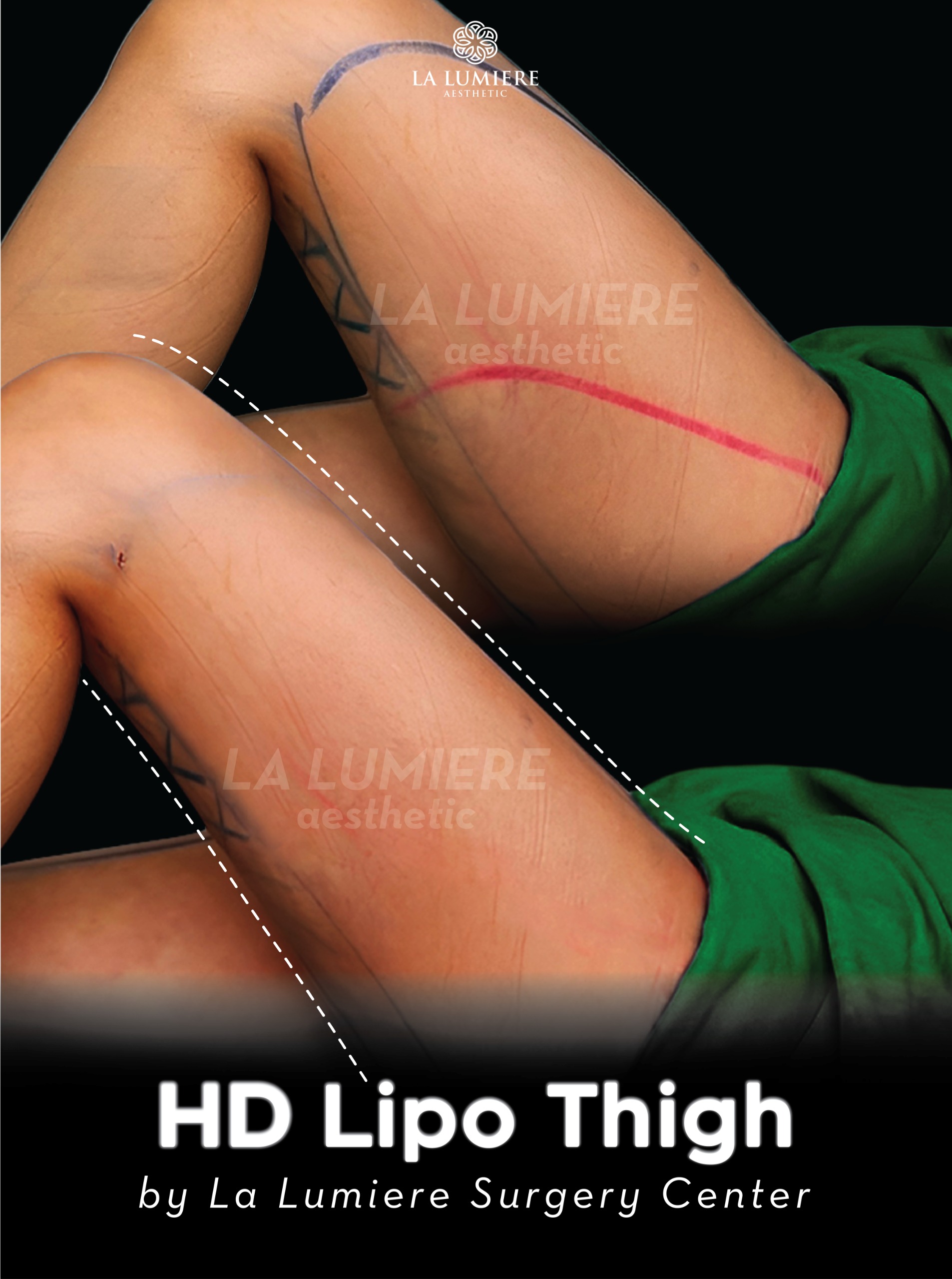 before-after-liposuction-la-lumiere-aesthetics-jakarta-01