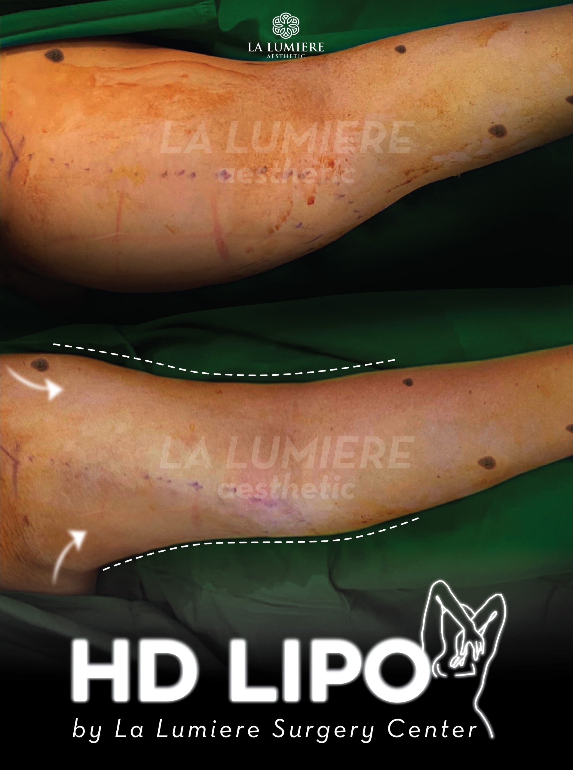 before-after-liposuction-la-lumiere-aesthetics-jakarta-02