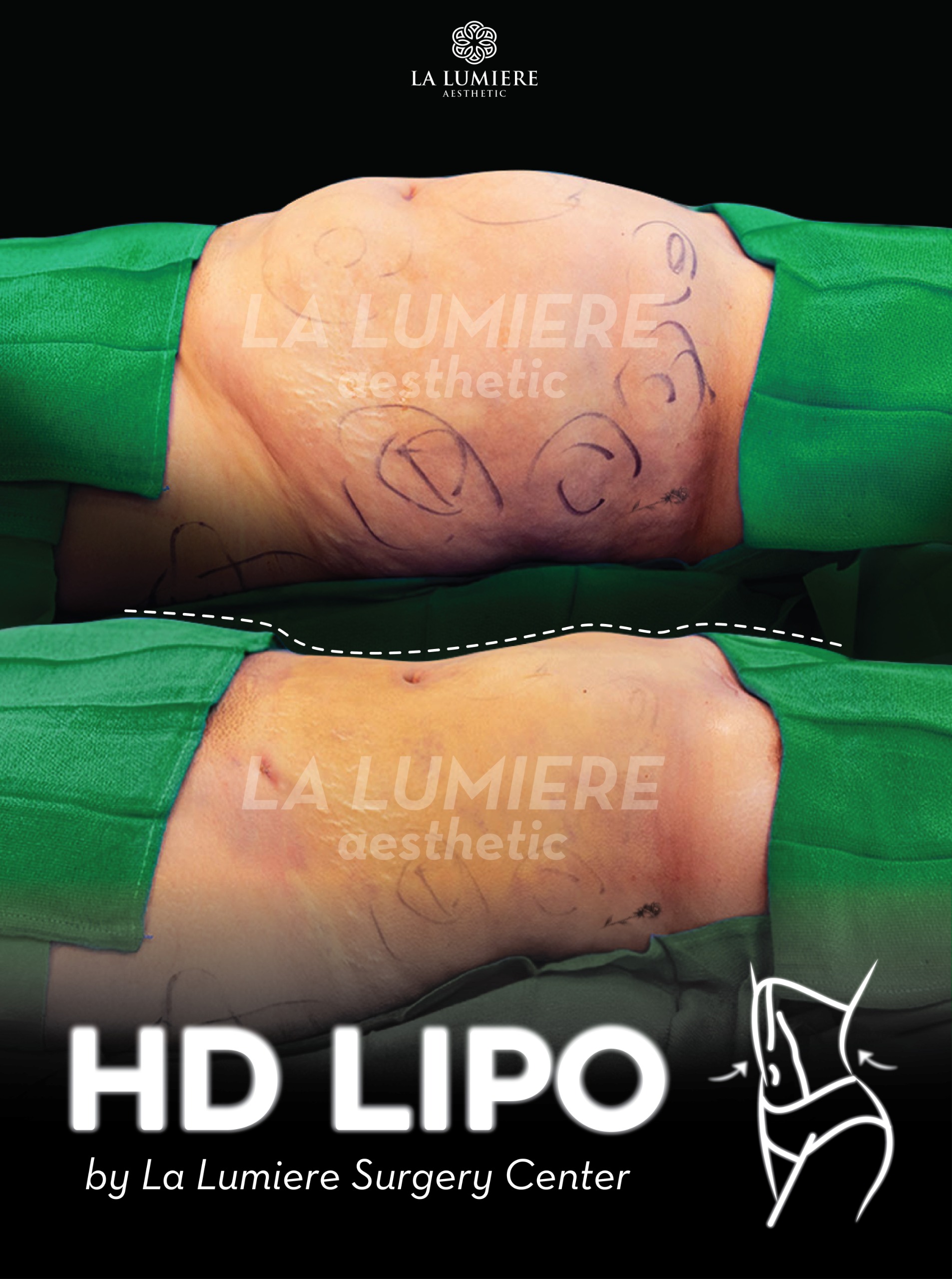 before-after-liposuction-la-lumiere-aesthetics-jakarta-03