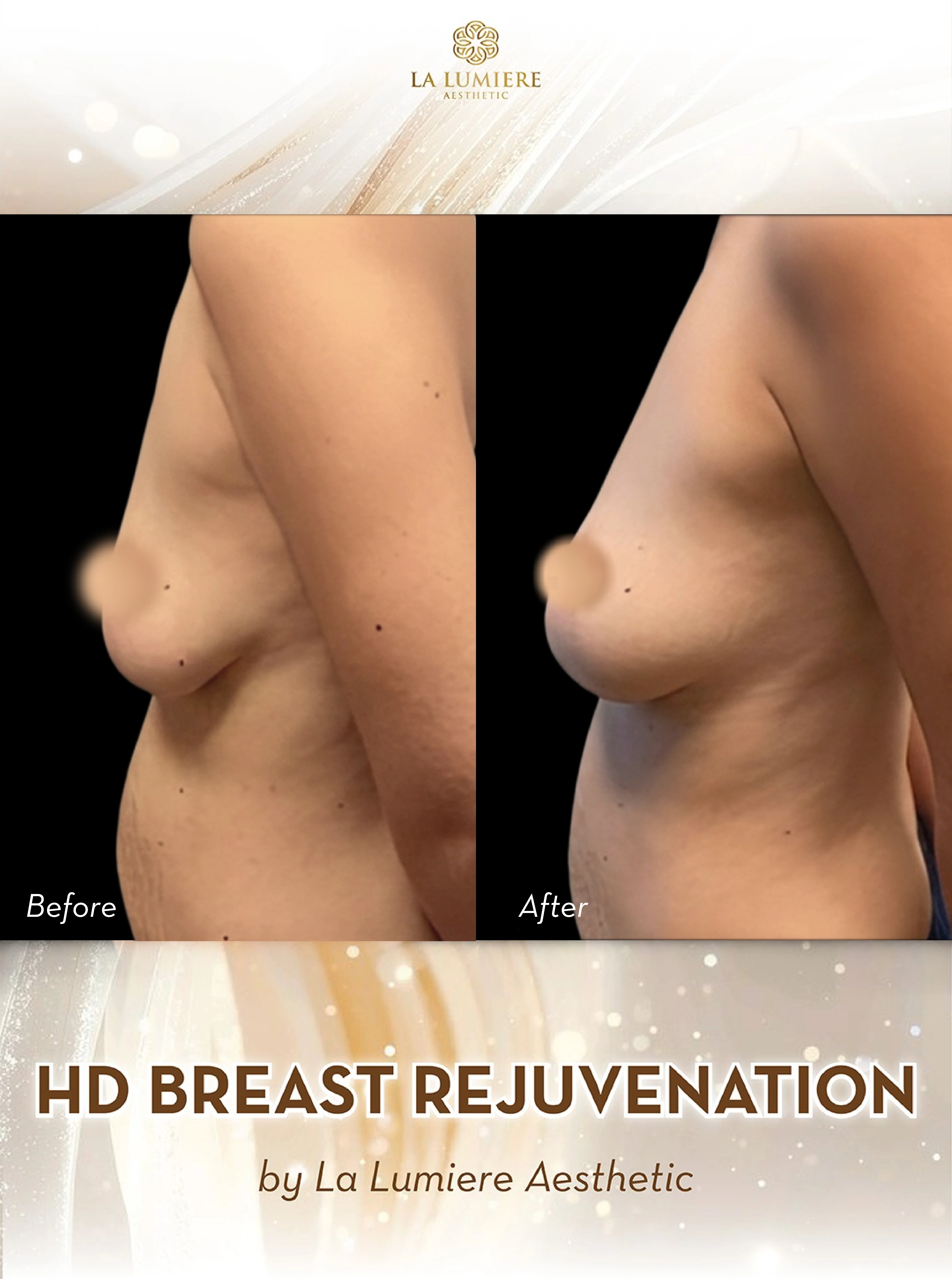 breast-injection-before-after-2
